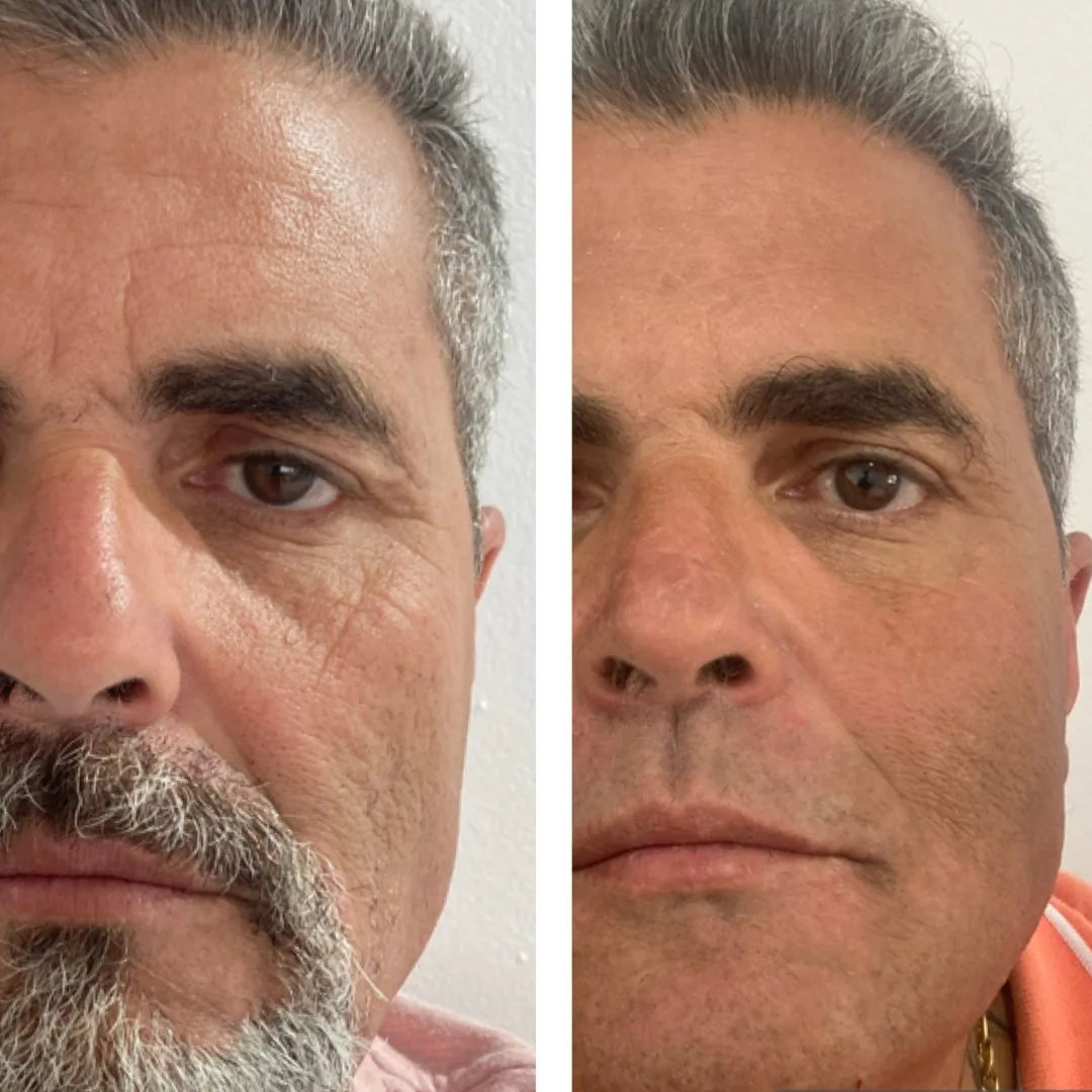 Antes e depois de tratamento facial com exossomos na Clin Clin, em Belo Horizonte