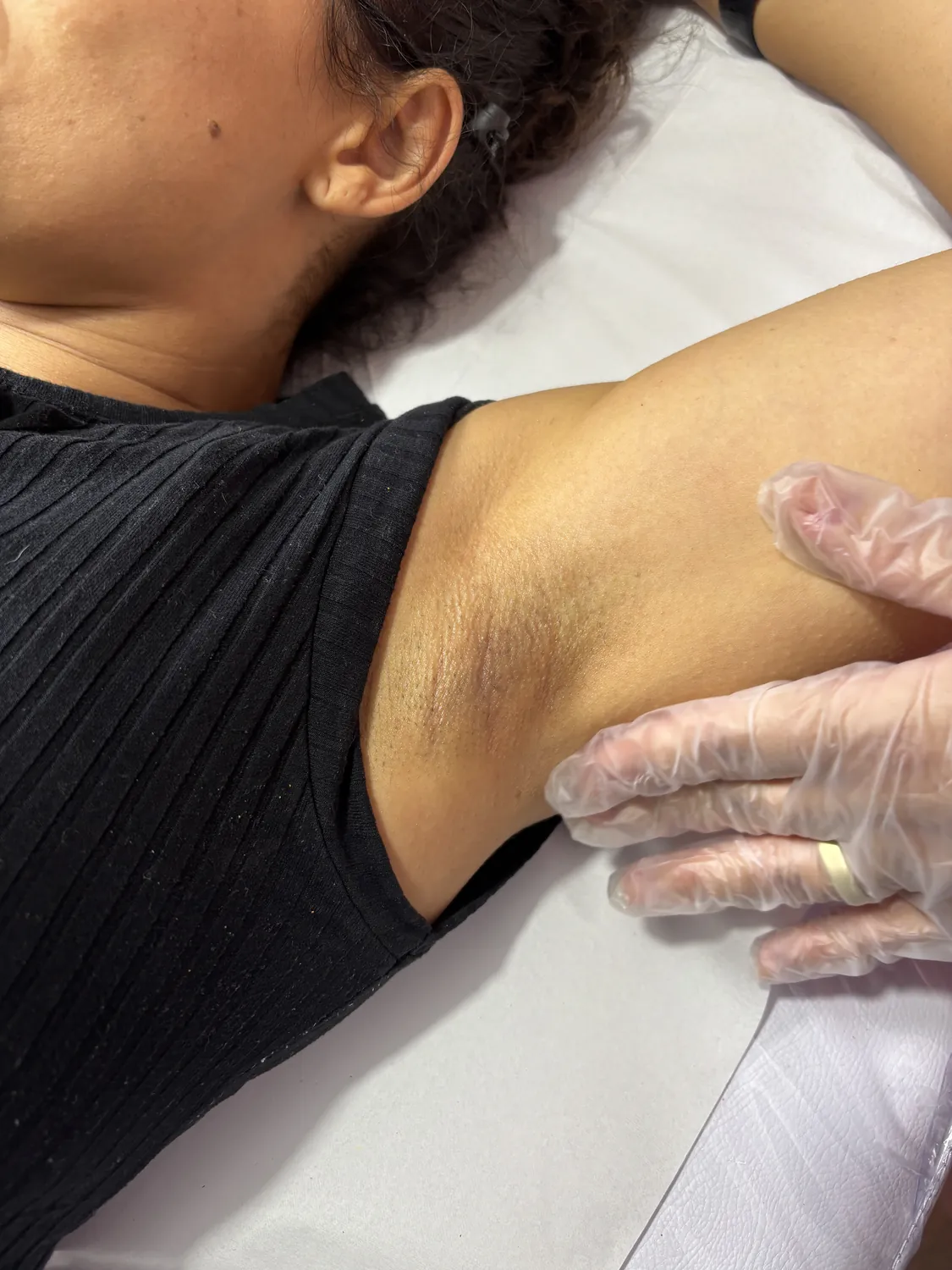 Depilação a laser de axila em atendimento na Clin Clin, BH