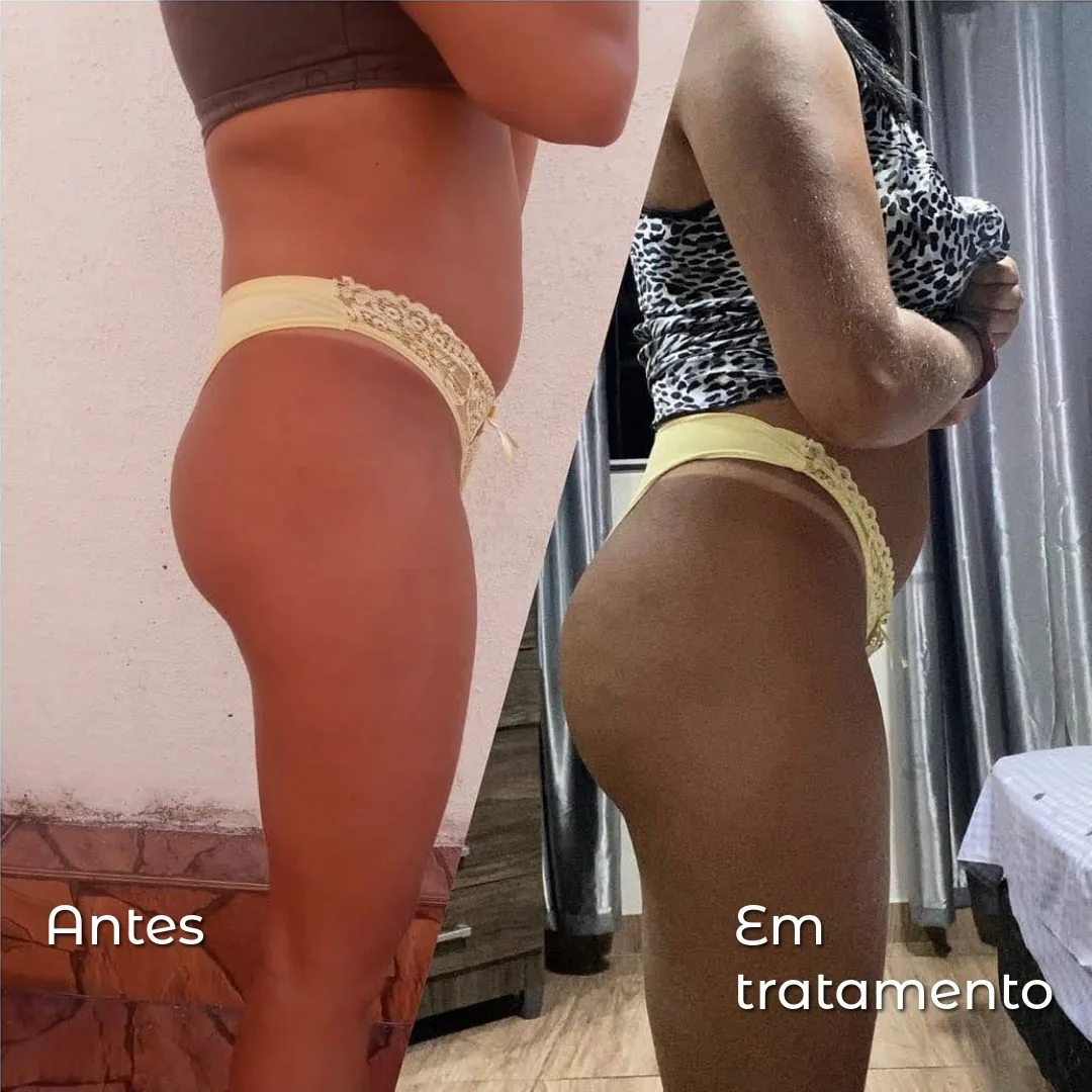 Resultado de harmonização de glúteos em tratamento na Clin Clin, BH, vista lateral