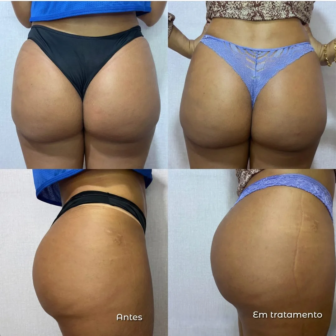Resultado de harmonização de glúteos em tratamento na Clin Clin, BH, vista posterior e lateral