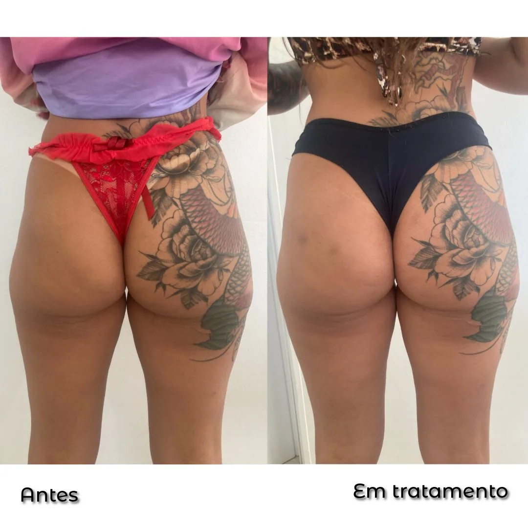 Resultado de harmonização de glúteos em tratamento na Clin Clin, BH, vista posterior