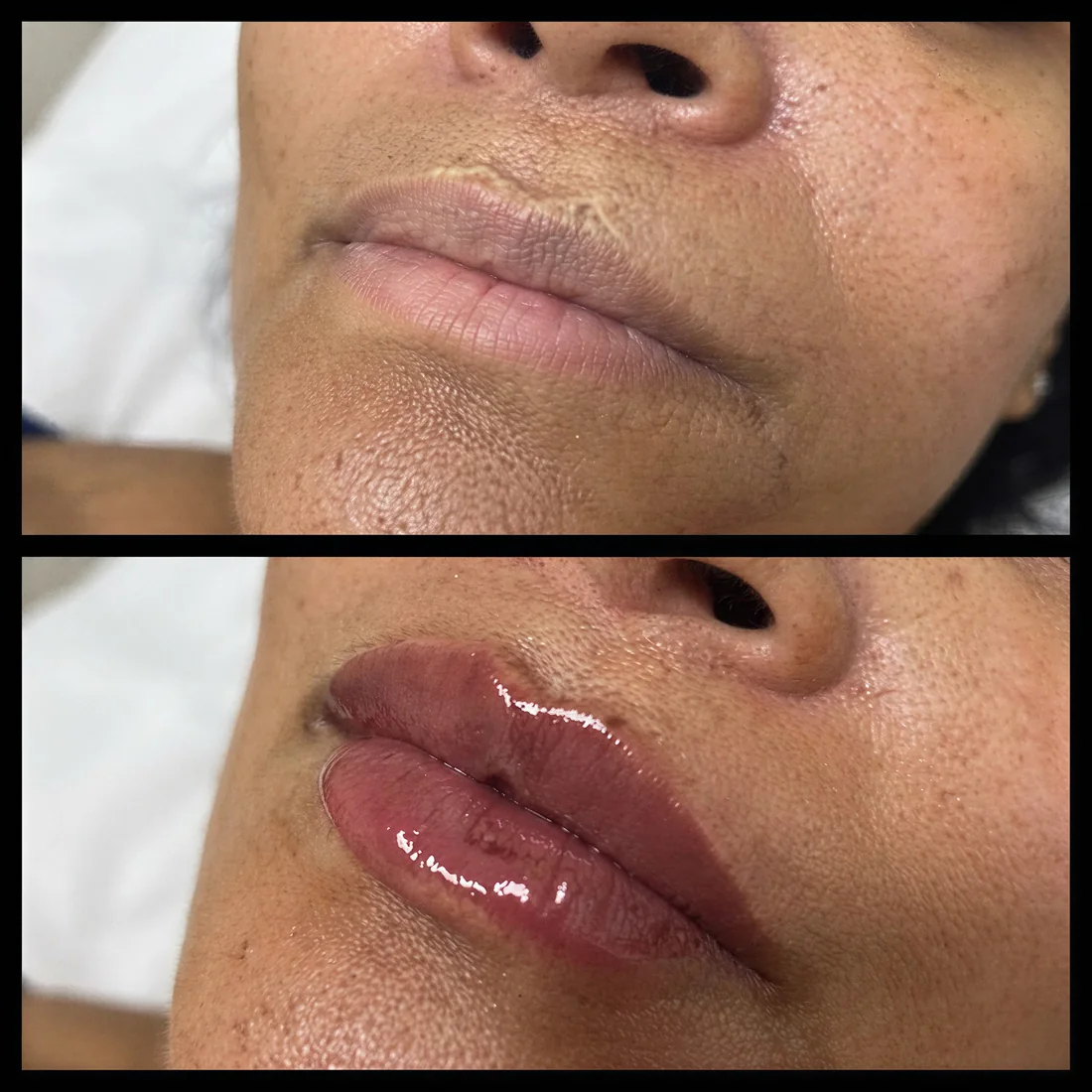 Antes e depois de preenchimento labial com ácido hialurônico: lábios com mais contorno e hidratação, paciente da Clin Clin em BH