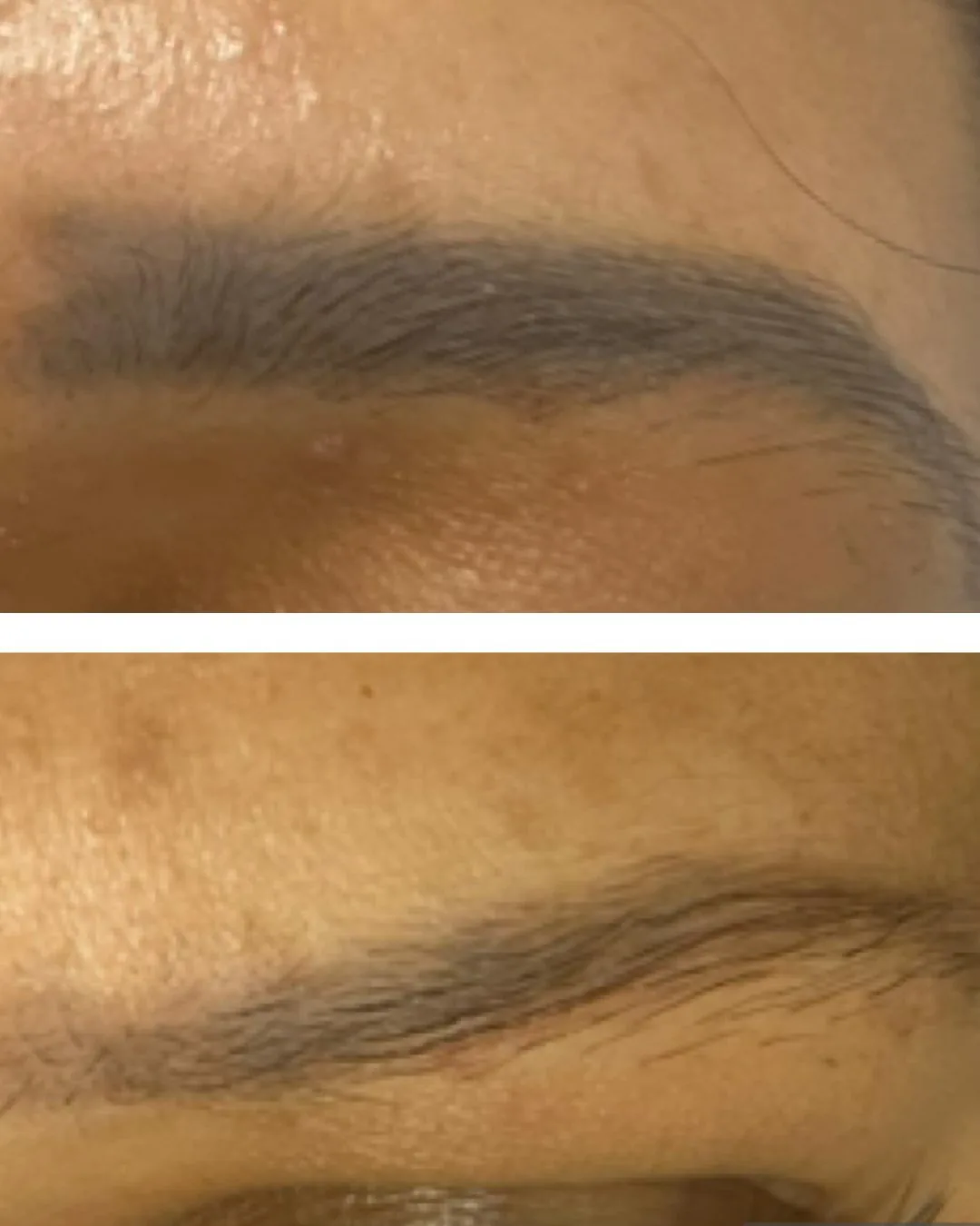 Antes e depois de remoção de micropigmentação de sobrancelha na Clin Clin, BH