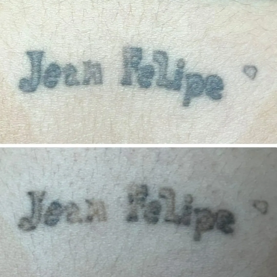 Antes e depois de remoção de tatuagem escrita no pulso na Clin Clin, BH
