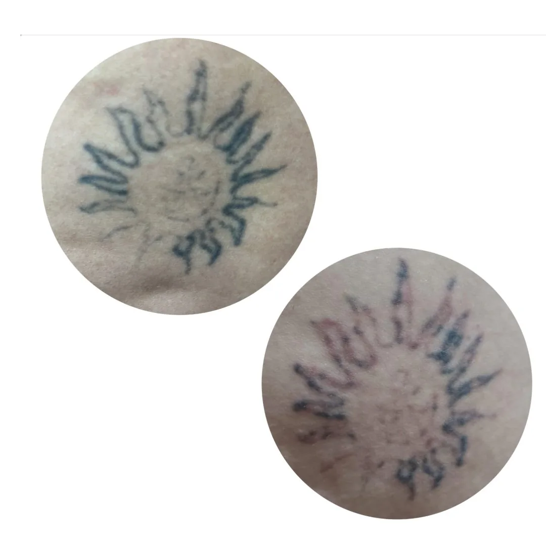 Antes e depois de remoção de tatuagem em formato de sol na Clin Clin, BH