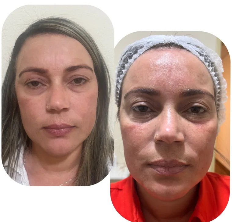 Antes e depois de protocolo facial regenerativo na Clin Clin, em Belo Horizonte