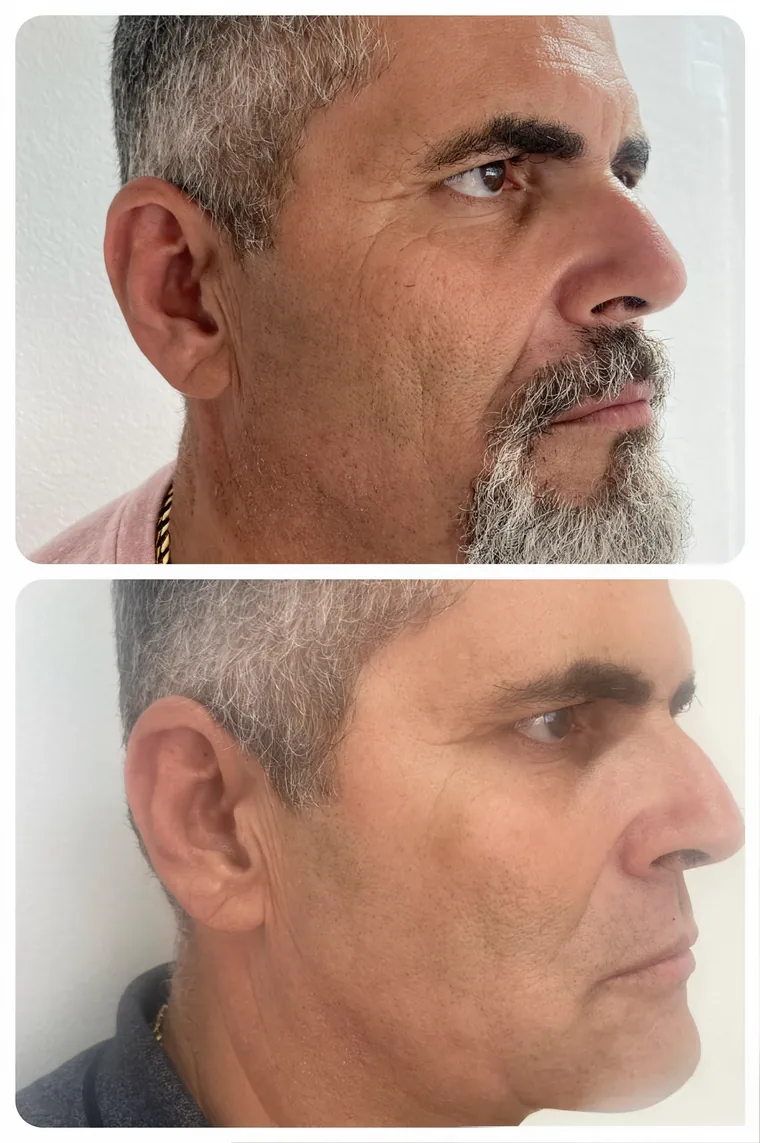 Antes e depois de tratamento regenerativo facial masculino na Clin Clin, em Belo Horizonte