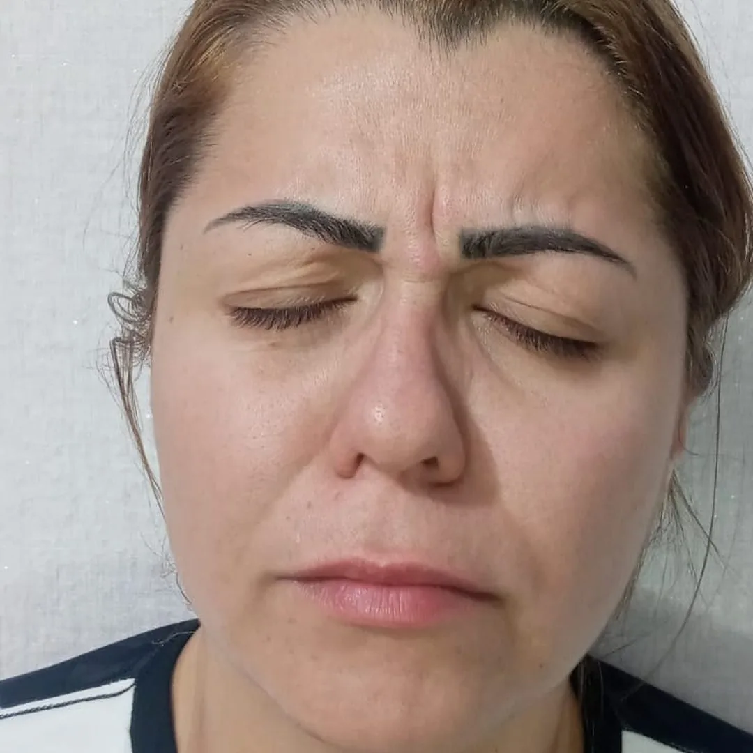 Antes da toxina botulínica: ruga entre as sobrancelhas, paciente da Clin Clin em BH