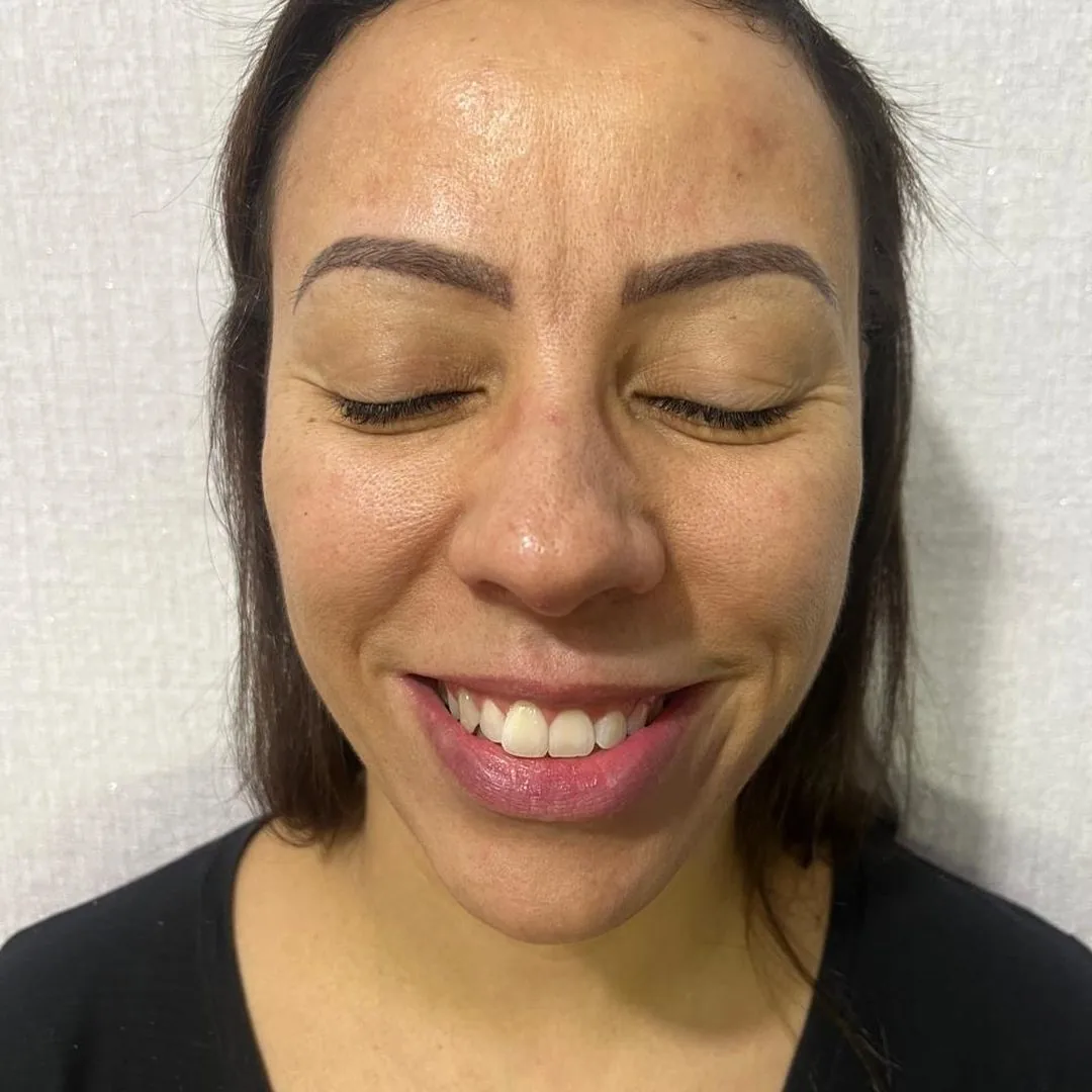 Depois da toxina botulínica: testa lisa com sorriso natural, paciente da Clin Clin em BH