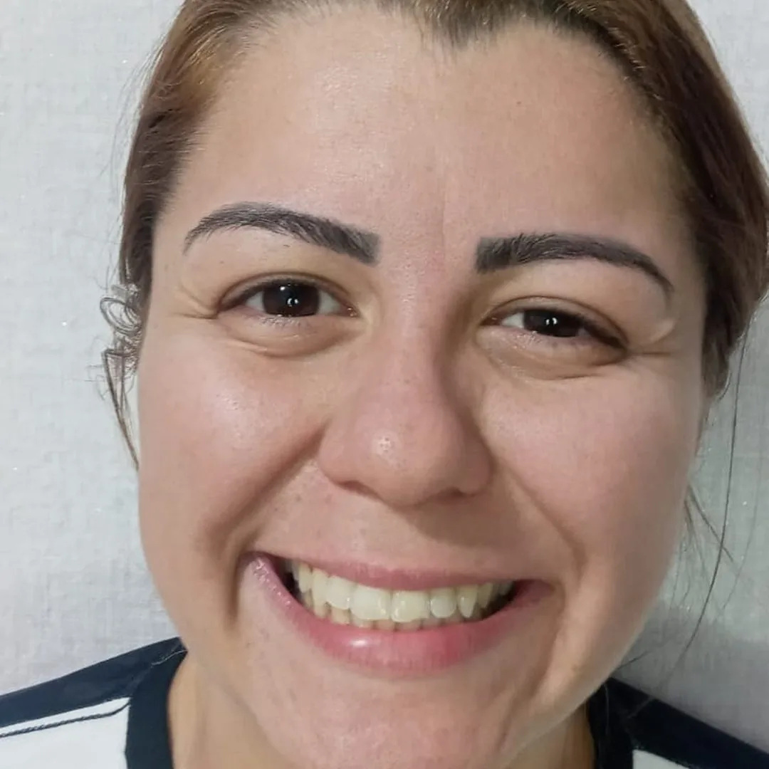 Depois da toxina botulínica: glabela suavizada e sorriso preservado, paciente da Clin Clin em BH